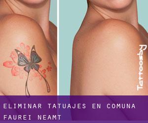 Eliminar tatuajes en Comuna Fãurei (Neamţ)
