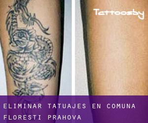 Eliminar tatuajes en Comuna Floreşti (Prahova)