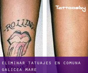 Eliminar tatuajes en Comuna Galicea Mare