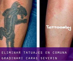 Eliminar tatuajes en Comuna Grădinari (Caraş-Severin)