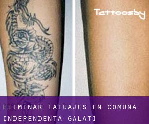 Eliminar tatuajes en Comuna Independenţa (Galaţi)