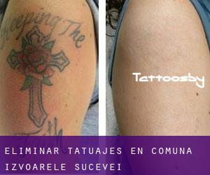 Eliminar tatuajes en Comuna Izvoarele Sucevei