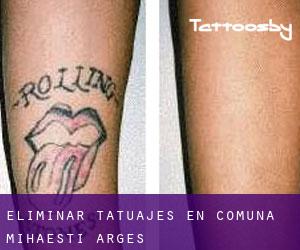 Eliminar tatuajes en Comuna Mihăeşti (Argeş)