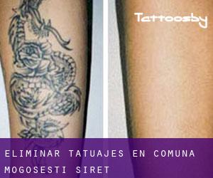 Eliminar tatuajes en Comuna Mogoşeşti-Siret
