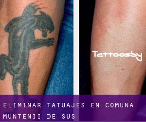 Eliminar tatuajes en Comuna Muntenii de Sus