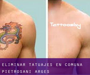 Eliminar tatuajes en Comuna Pietroşani (Argeş)
