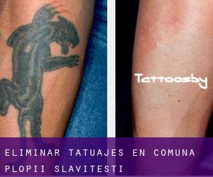 Eliminar tatuajes en Comuna Plopii Slăviţeşti