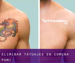 Eliminar tatuajes en Comuna Pomi