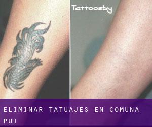 Eliminar tatuajes en Comuna Pui