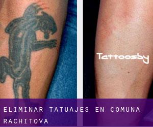 Eliminar tatuajes en Comuna Răchitova