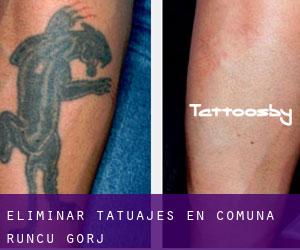 Eliminar tatuajes en Comuna Runcu (Gorj)