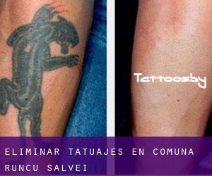 Eliminar tatuajes en Comuna Runcu Salvei