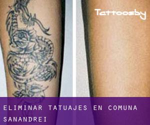 Eliminar tatuajes en Comuna Sânandrei