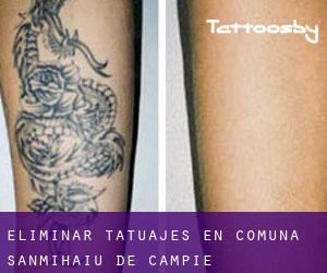 Eliminar tatuajes en Comuna Sânmihaiu de Câmpie