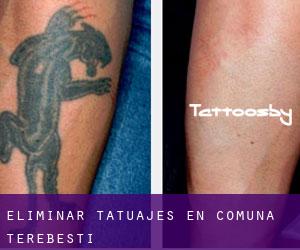 Eliminar tatuajes en Comuna Terebeşti