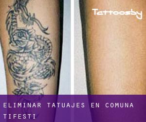 Eliminar tatuajes en Comuna Ţifeşti