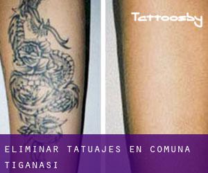 Eliminar tatuajes en Comuna Ţigănaşi