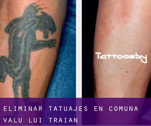Eliminar tatuajes en Comuna Valu lui Traian