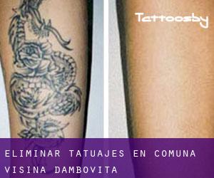 Eliminar tatuajes en Comuna Vişina (Dâmboviţa)