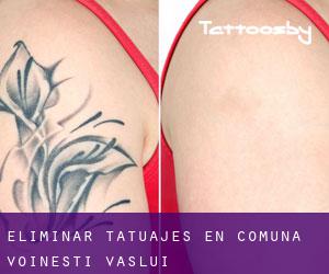 Eliminar tatuajes en Comuna Voineşti (Vaslui)