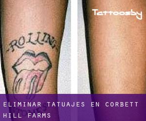 Eliminar tatuajes en Corbett Hill Farms
