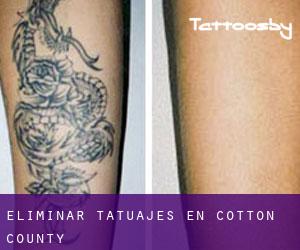 Eliminar tatuajes en Cotton County