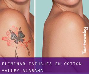 Eliminar tatuajes en Cotton Valley (Alabama)