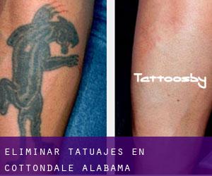 Eliminar tatuajes en Cottondale (Alabama)