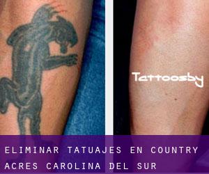 Eliminar tatuajes en Country Acres (Carolina del Sur)