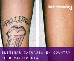 Eliminar tatuajes en Country Club (California)