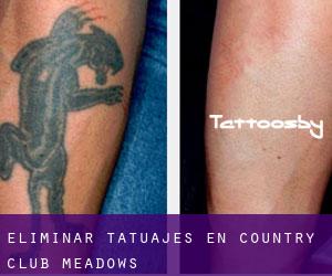 Eliminar tatuajes en Country Club Meadows