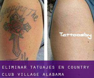 Eliminar tatuajes en Country Club Village (Alabama)