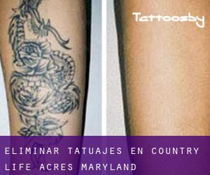 Eliminar tatuajes en Country Life Acres (Maryland)