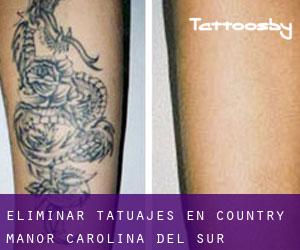 Eliminar tatuajes en Country Manor (Carolina del Sur)