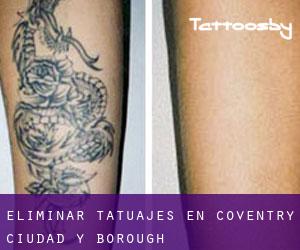 Eliminar tatuajes en Coventry (Ciudad y Borough)