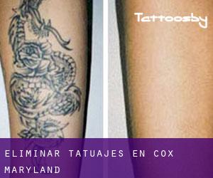 Eliminar tatuajes en Cox (Maryland)