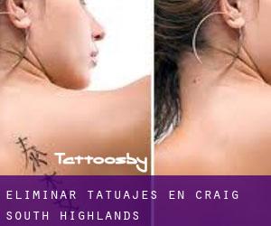 Eliminar tatuajes en Craig South Highlands