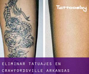 Eliminar tatuajes en Crawfordsville (Arkansas)