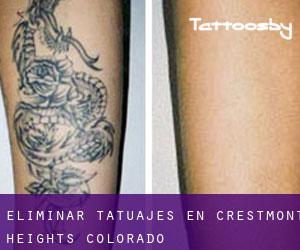 Eliminar tatuajes en Crestmont Heights (Colorado)