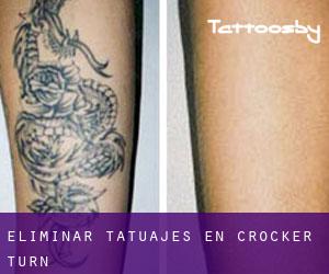 Eliminar tatuajes en Crocker Turn