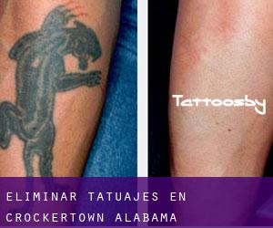 Eliminar tatuajes en Crockertown (Alabama)