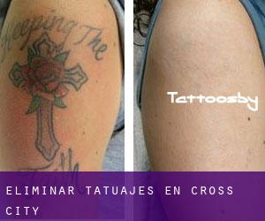 Eliminar tatuajes en Cross City