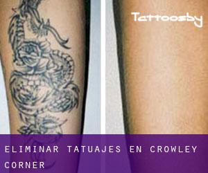 Eliminar tatuajes en Crowley Corner