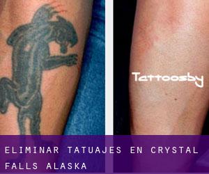 Eliminar tatuajes en Crystal Falls (Alaska)