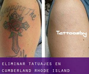 Eliminar tatuajes en Cumberland (Rhode Island)
