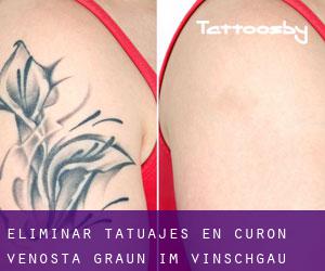 Eliminar tatuajes en Curon Venosta - Graun im Vinschgau