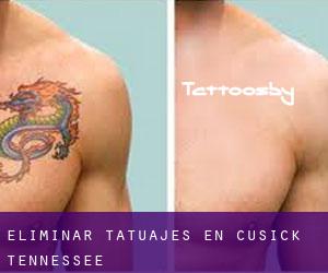 Eliminar tatuajes en Cusick (Tennessee)