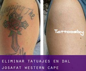 Eliminar tatuajes en Dal Josafat (Western Cape)