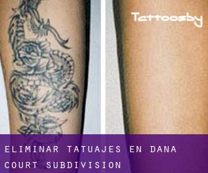 Eliminar tatuajes en Dana Court Subdivision