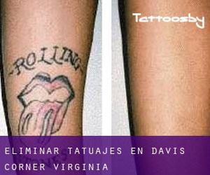 Eliminar tatuajes en Davis Corner (Virginia)